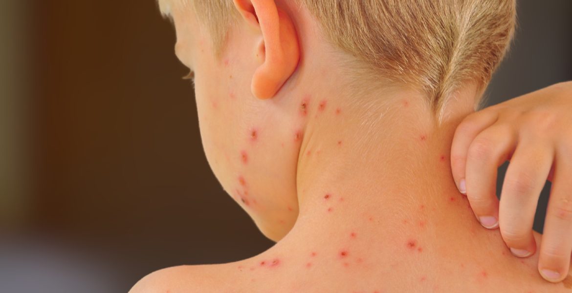 Alla barn ska få gratis vattkoppsvaccin